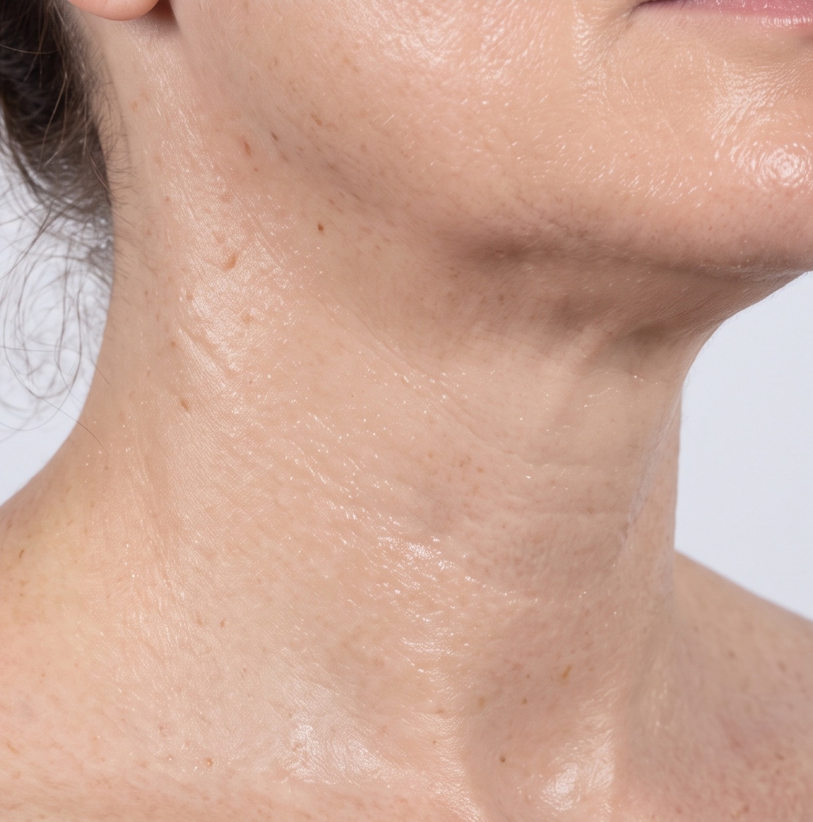 Skin Boosters — after treatment