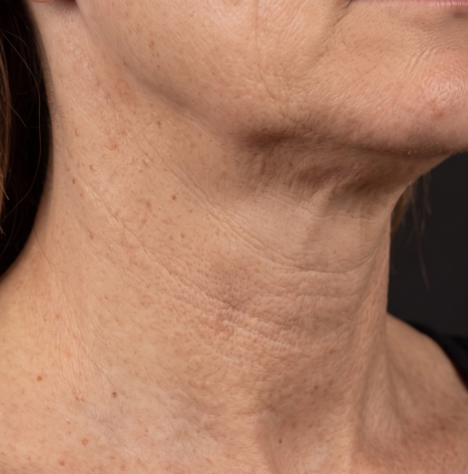 Skin Boosters — before treatment